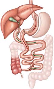 Duodenal Switch