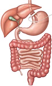 Revision Bariatric Surgery